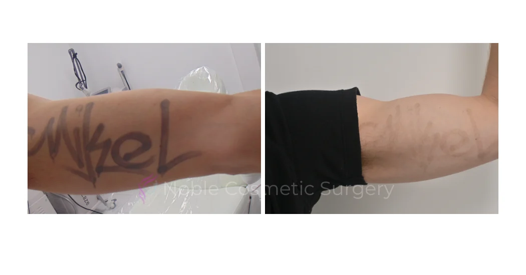 LASER-TATTOO-REMOVAL-CASE-00004 | Before and After Laser Tattoo Removal 1