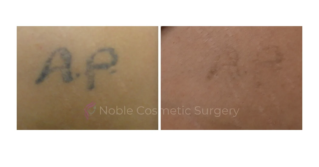 LASER-TATTOO-REMOVAL-CASE-00003 | Before and After Laser Tattoo Removal 1