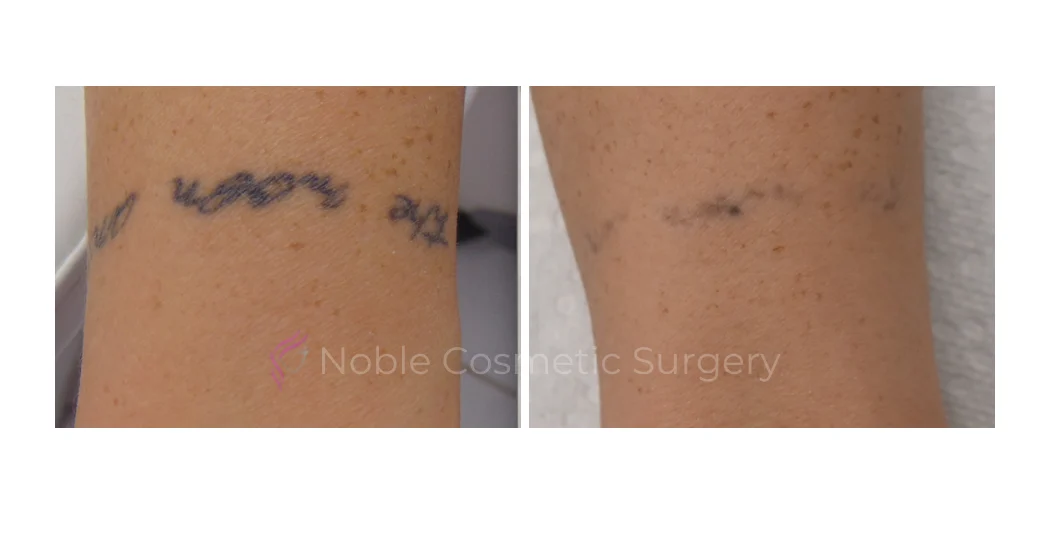 LASER-TATTOO-REMOVAL-CASE-00005 | Before and After Laser Tattoo Removal 1
