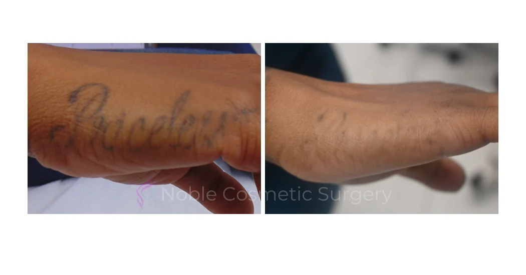 LASER-TATTOO-REMOVAL-CASE-00006 | Before and After Laser Tattoo Removal 1