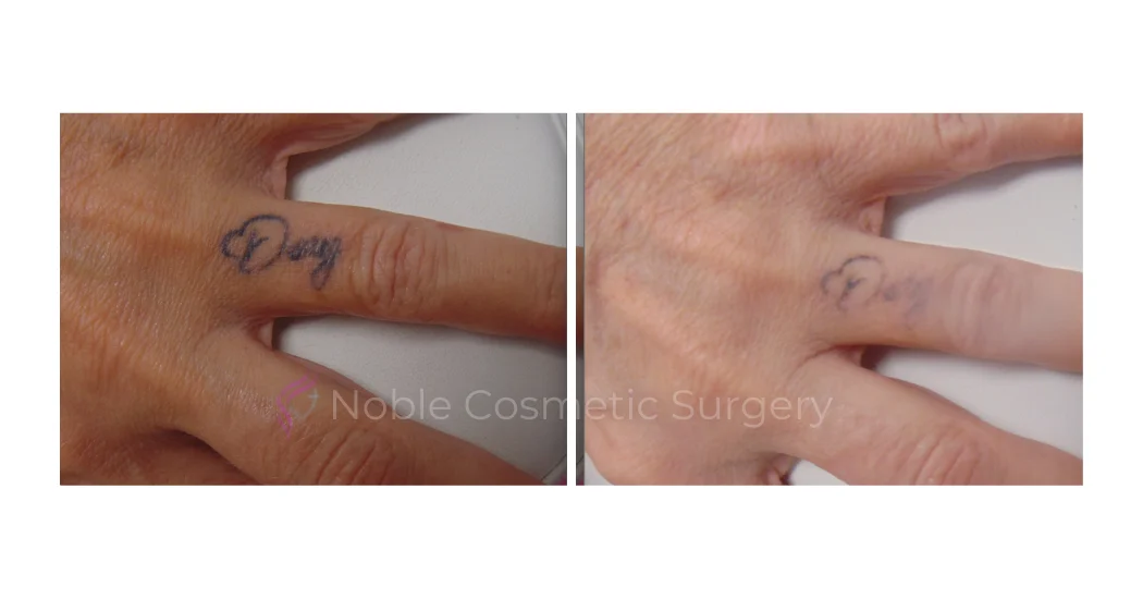 LASER-TATTOO-REMOVAL-CASE-00007 | Before and After Laser Tattoo Removal 1