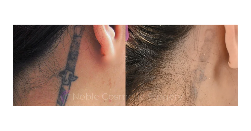 LASER-TATTOO-REMOVAL-CASE-00008 | Before and After Laser Tattoo Removal 1