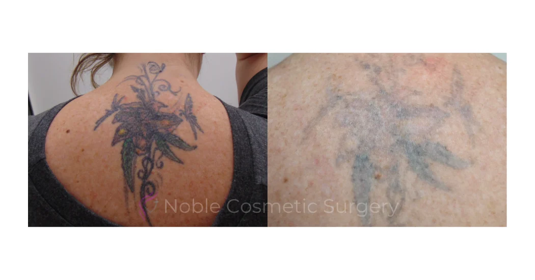 LASER-TATTOO-REMOVAL-CASE-00009 | Before and After Laser Tattoo Removal 1