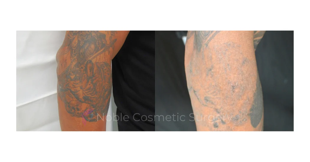 LASER-TATTOO-REMOVAL-CASE-00010 | Before and After Laser Tattoo Removal 1