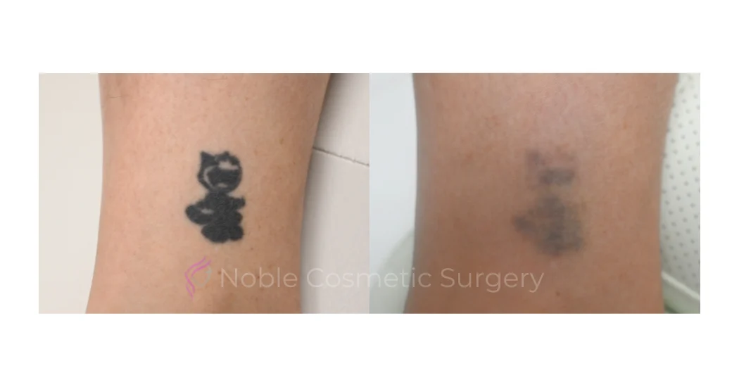 LASER-TATTOO-REMOVAL-CASE-00011 | Before and After Laser Tattoo Removal 1