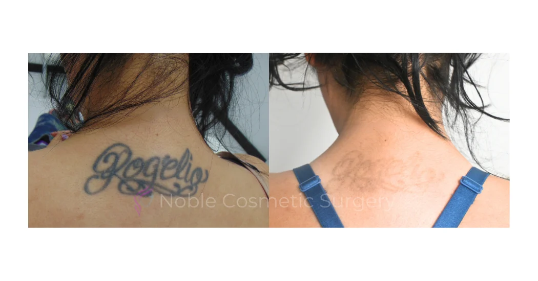 LASER-TATTOO-REMOVAL-CASE-00012 | Before and After Laser Tattoo Removal 1