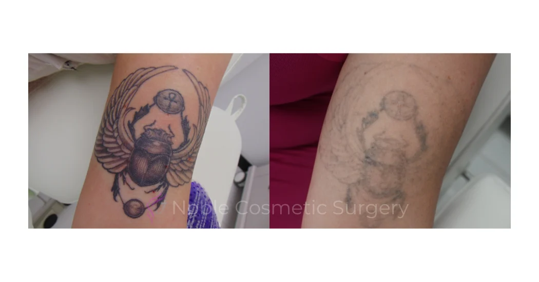 LASER-TATTOO-REMOVAL-CASE-00013 | Before and After Laser Tattoo Removal 1