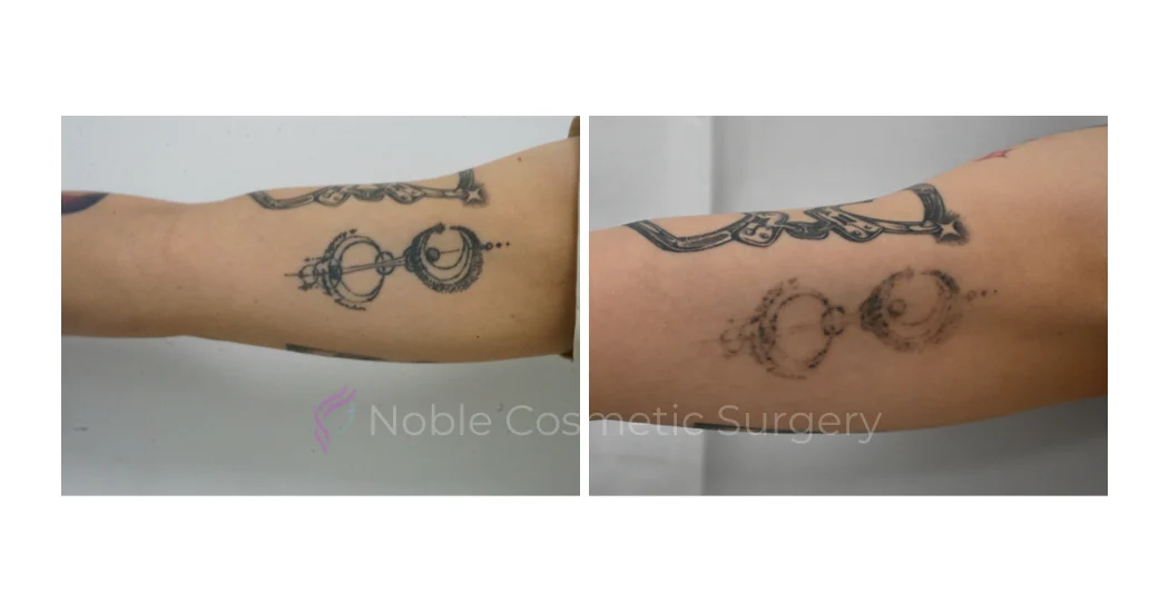 LASER-TATTOO-REMOVAL-CASE-00019 | Before and After Laser Tattoo Removal 1