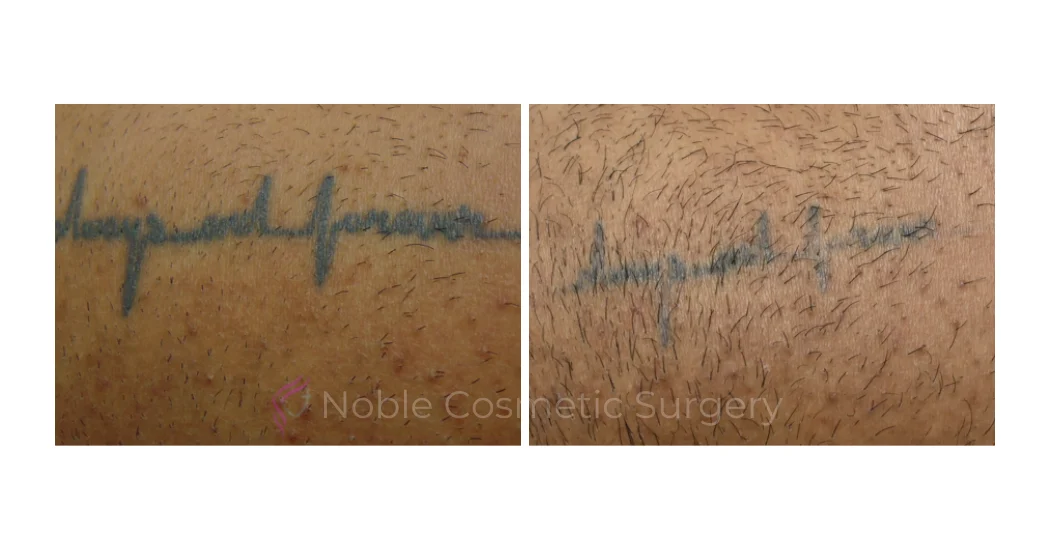 LASER-TATTOO-REMOVAL-CASE-00021 | Before and After Laser Tattoo Removal 1