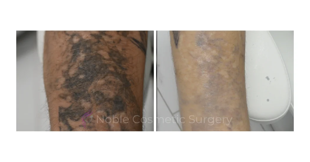 LASER-TATTOO-REMOVAL-CASE-00025 | Before and After Laser Tattoo Removal 1