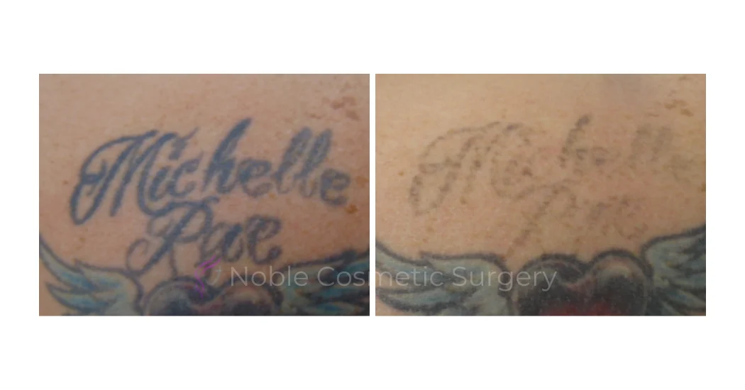 LASER-TATTOO-REMOVAL-CASE-00026 | Before and After Laser Tattoo Removal 1