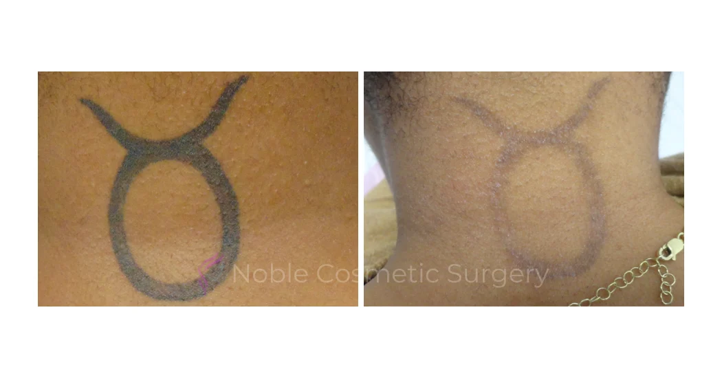 LASER-TATTOO-REMOVAL-CASE-00027 | Before and After Laser Tattoo Removal 1
