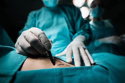 Is Liposuction an Alternative to Weight Loss?