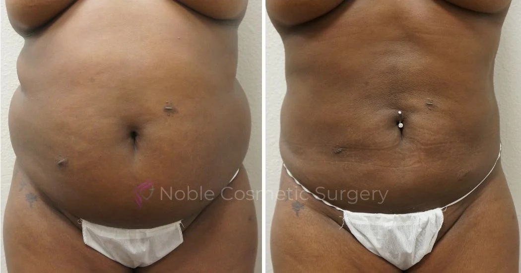 Liposuction 1