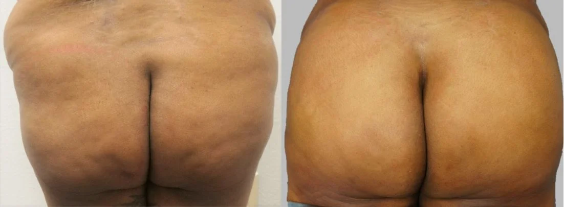 P1-00900 | Before and After Brazilian Butt Lift 1