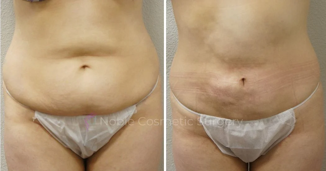 Liposuction 2
