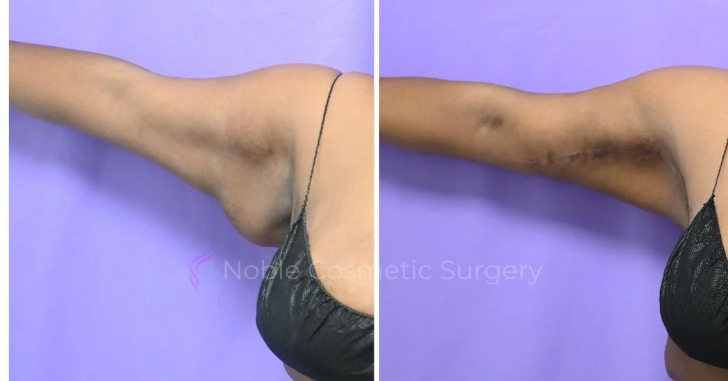 P1-13161 | Before and After Brachioplasty 1