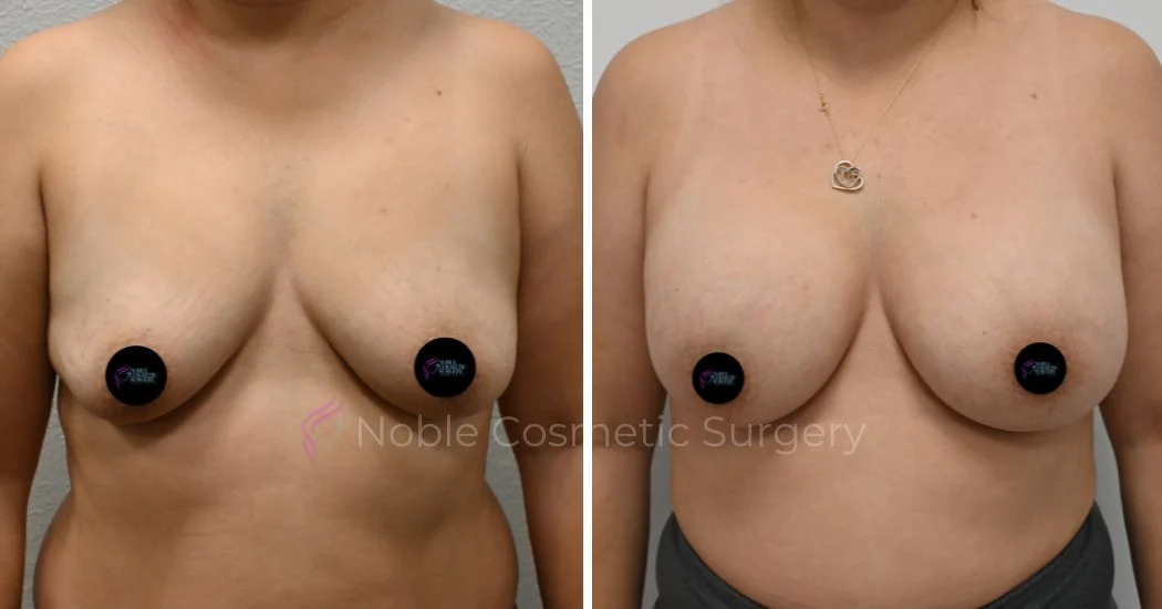 P1-15207 | Before and After Breast Augmentation 1