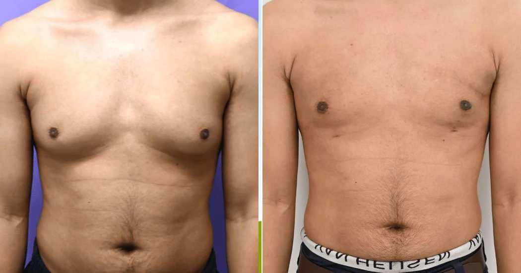 P1-19679 | Before and After Gynecomastia 1