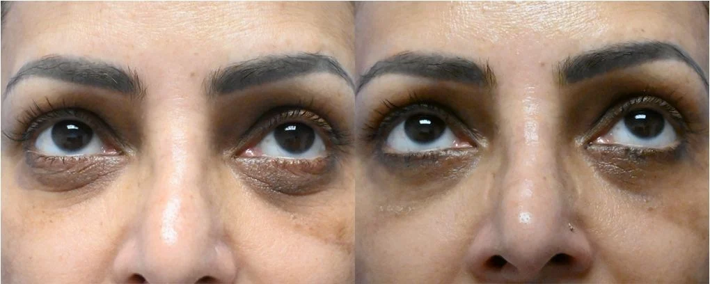 P1-19823 | Before and After Blepharoplasty 1