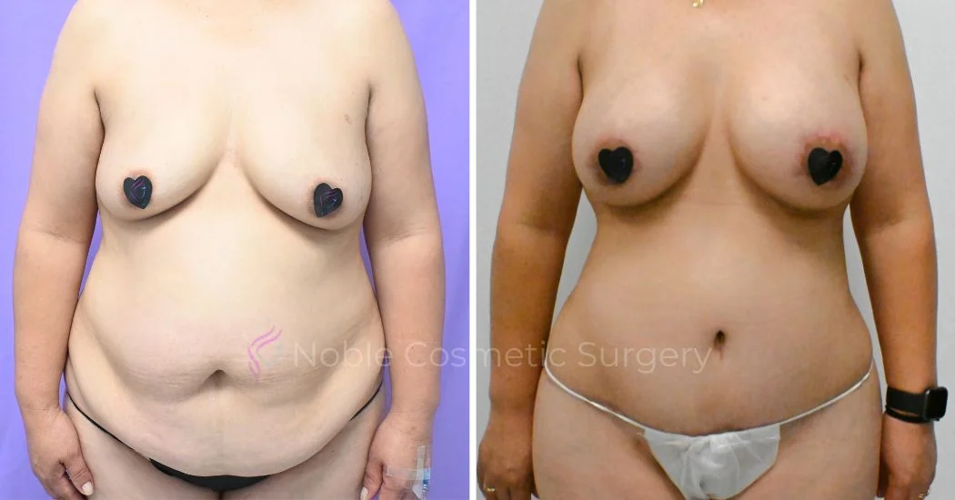 P1-MM19828 | Before and After Mommy Makeover 1