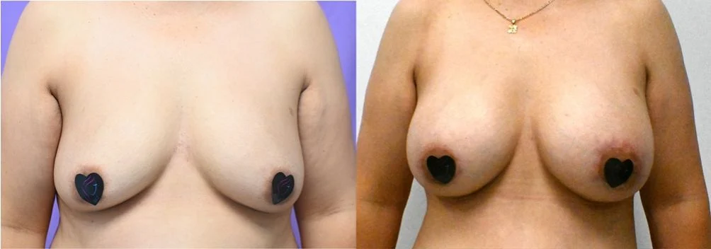 P1-19828 | Before and After Breast Augmentation with Lift 1