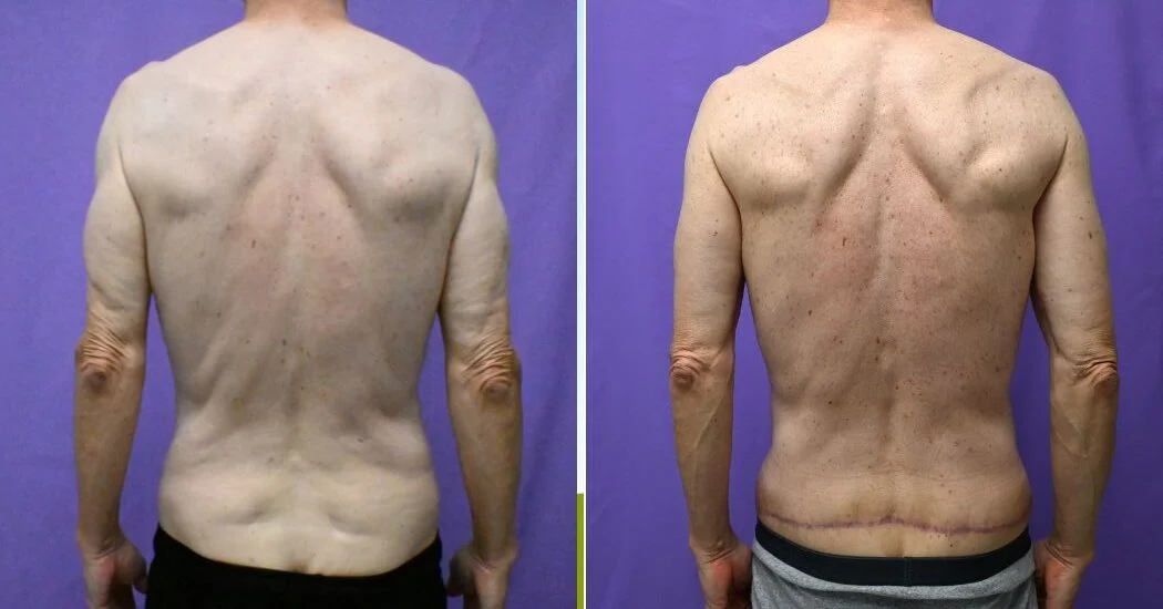P1-20051 | Before and After Back Lift 1