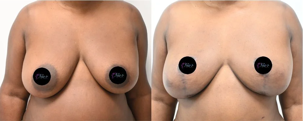 P1-3000 | Before and After Breast Reduction 1