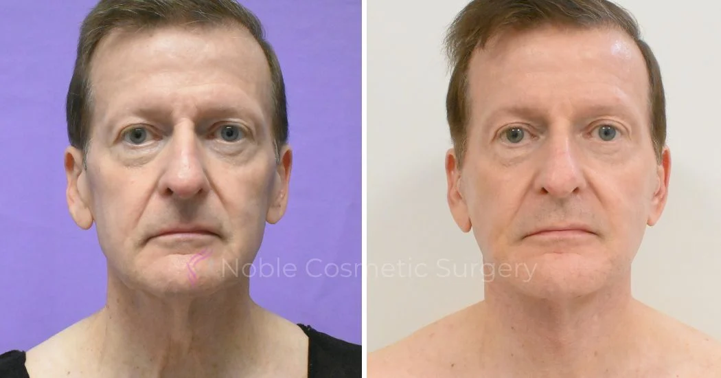 P1-F00800 | Before and After Facelift 1