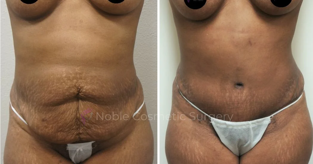 P10-00041A | Before and After Abdominoplasty 1
