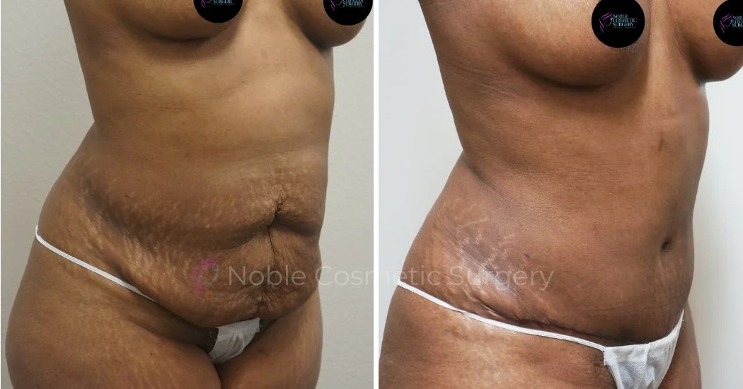 P10-00041A | Before and After Abdominoplasty 2