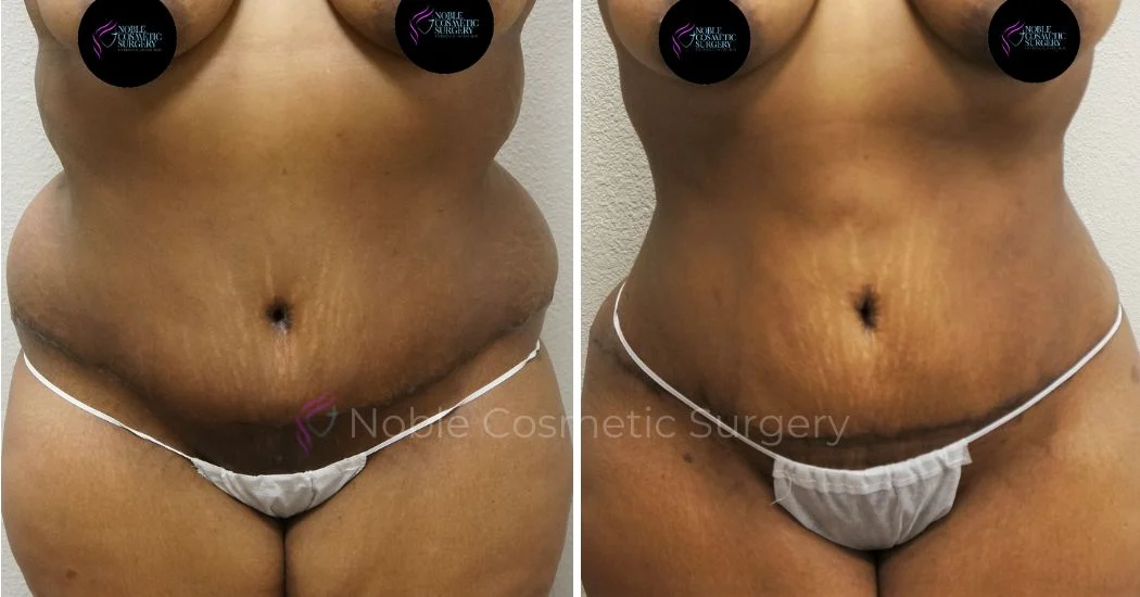 P11-00042A | Before and After Abdominoplasty 1