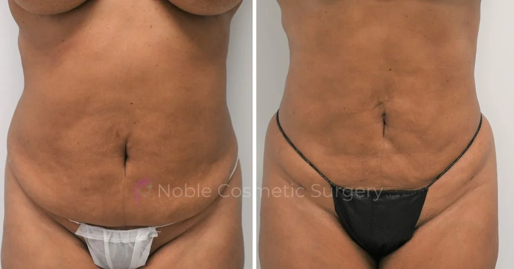 P11-00911L | Before and After Liposuction 1