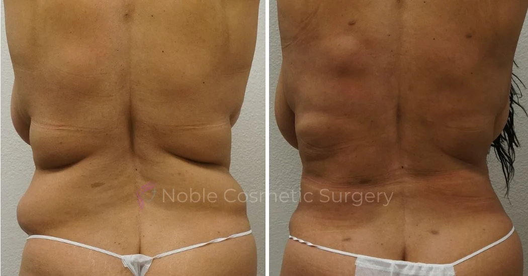 P12-00043A | Before and After Abdominoplasty 3