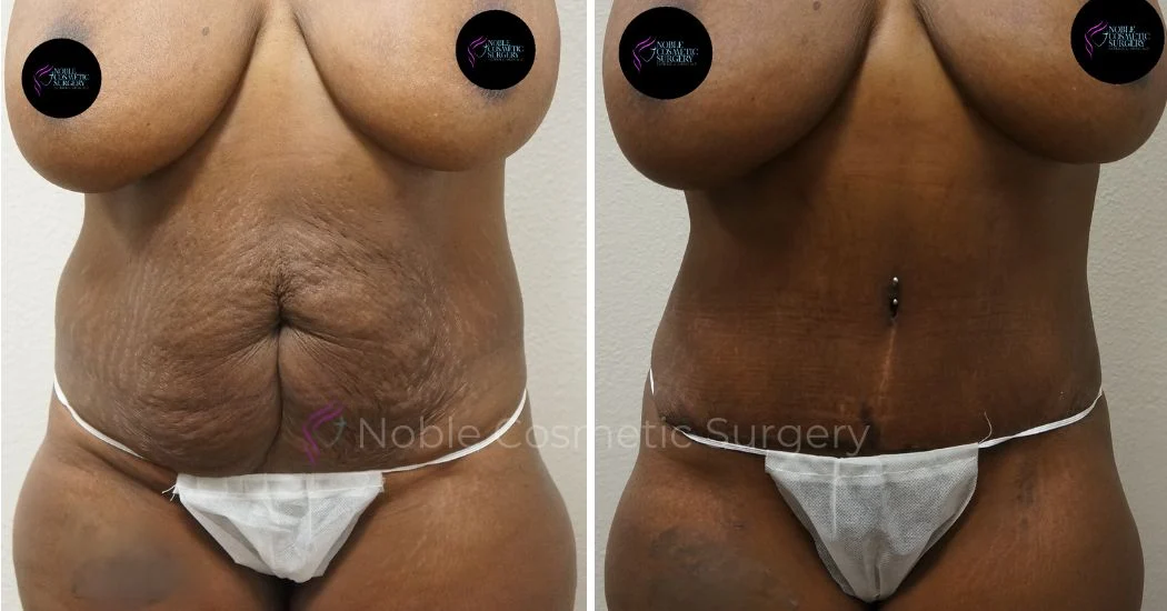 P13-00044A | Before and After Abdominoplasty 1