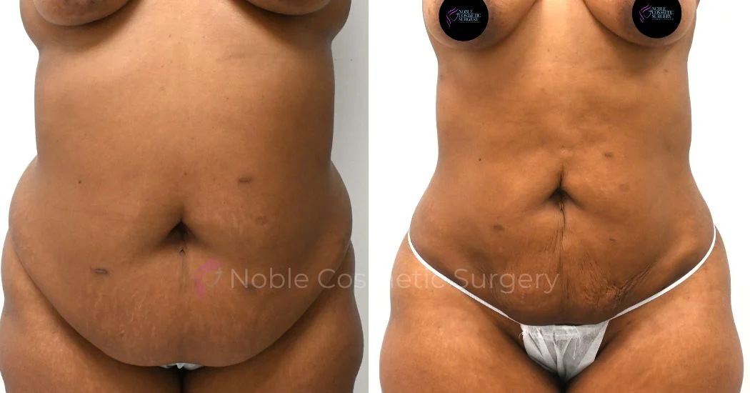 P14-00914L | Before and After Liposuction 1