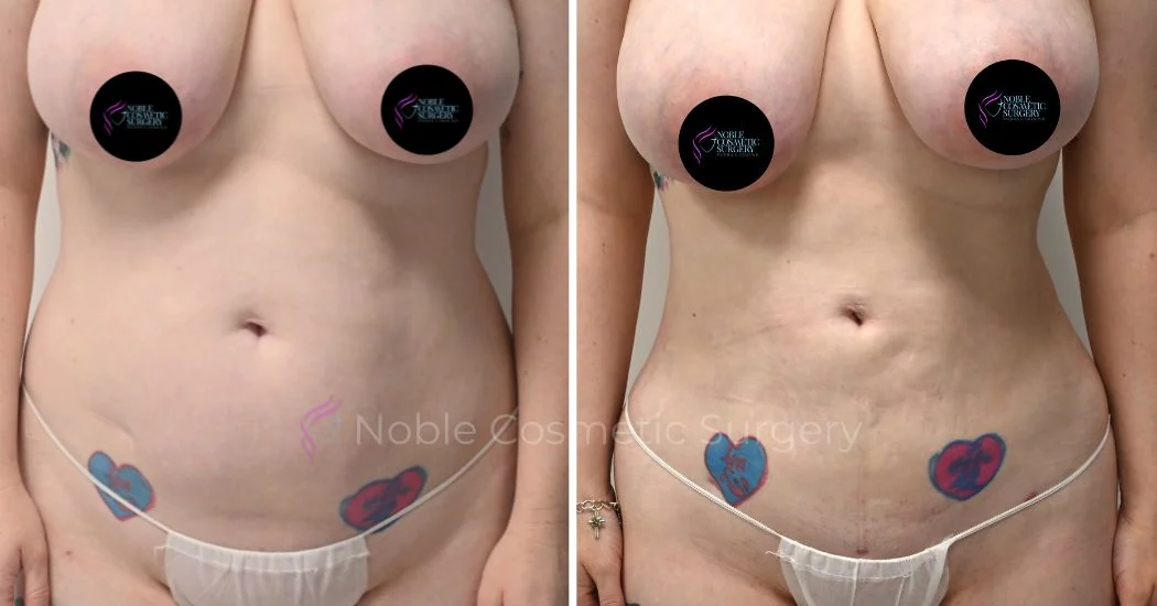 P15-00915L | Before and After Liposuction 1