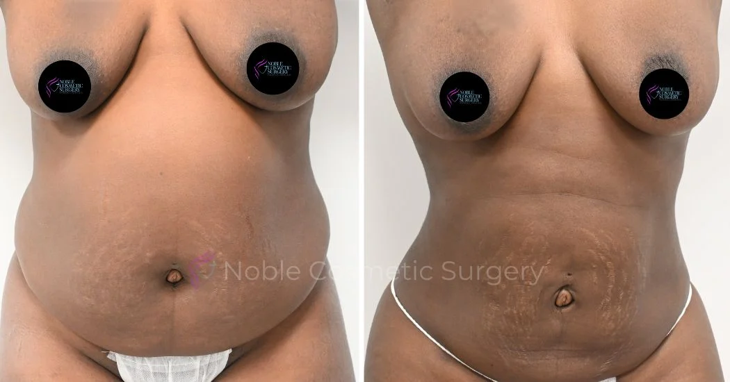 P16-00916L | Before and After Liposuction 1