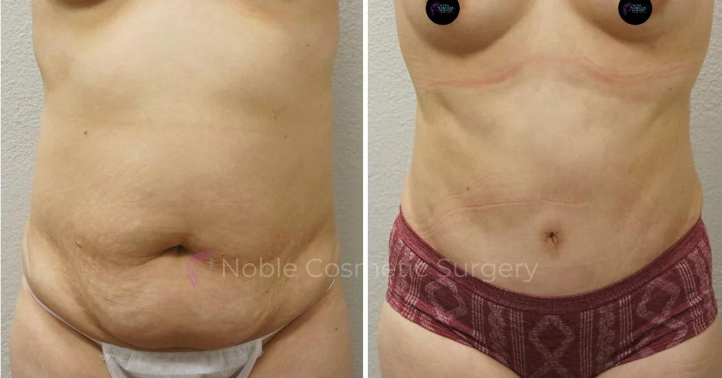 P18-00049A | Before and After Abdominoplasty 1