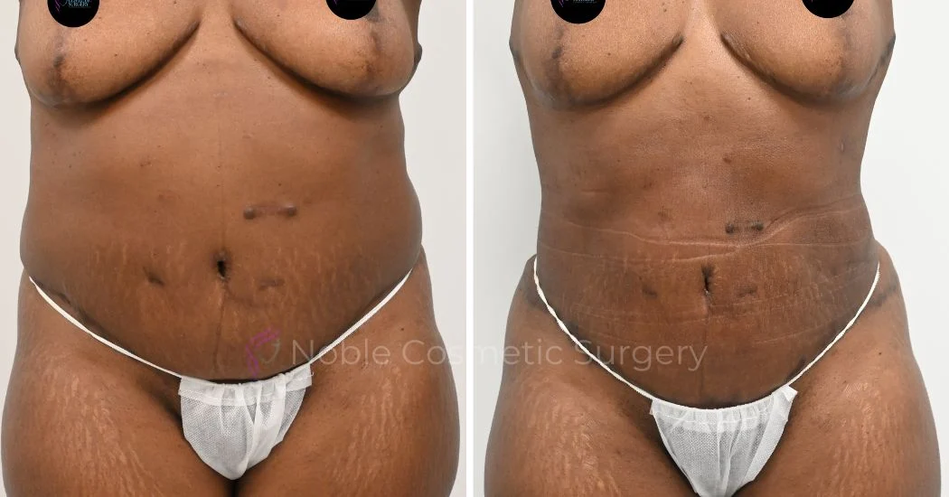 P18-00918L | Before and After Liposuction 1