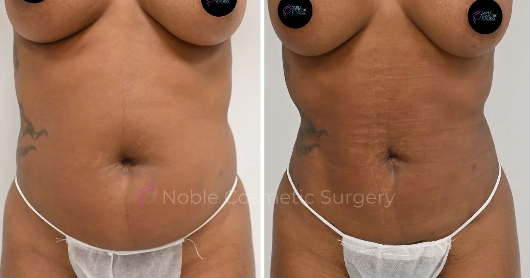 P19-00919L | Before and After Liposuction 1
