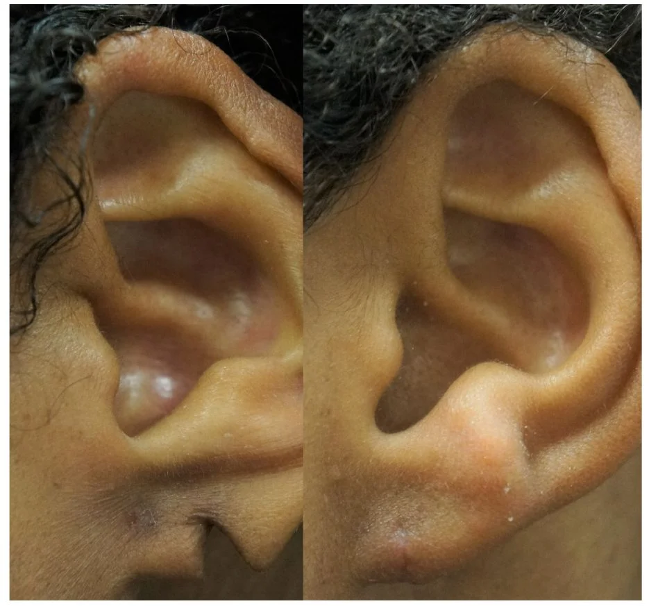 P2-00801E | Before and After Earlobe Repair 1
