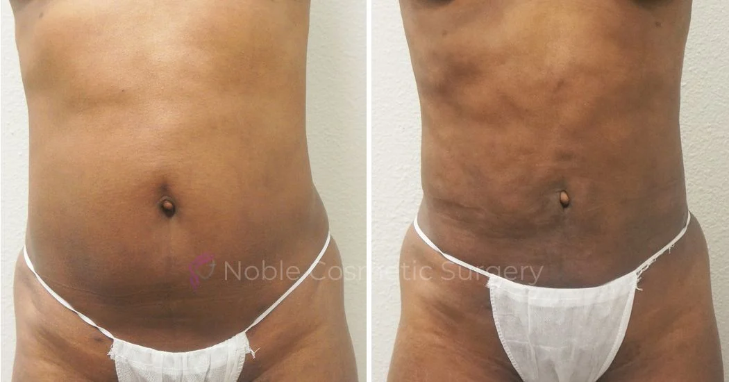 Liposuction 3