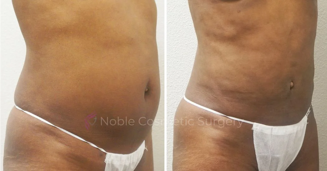 P2-00902L | Before and After Abdominoplasty 2