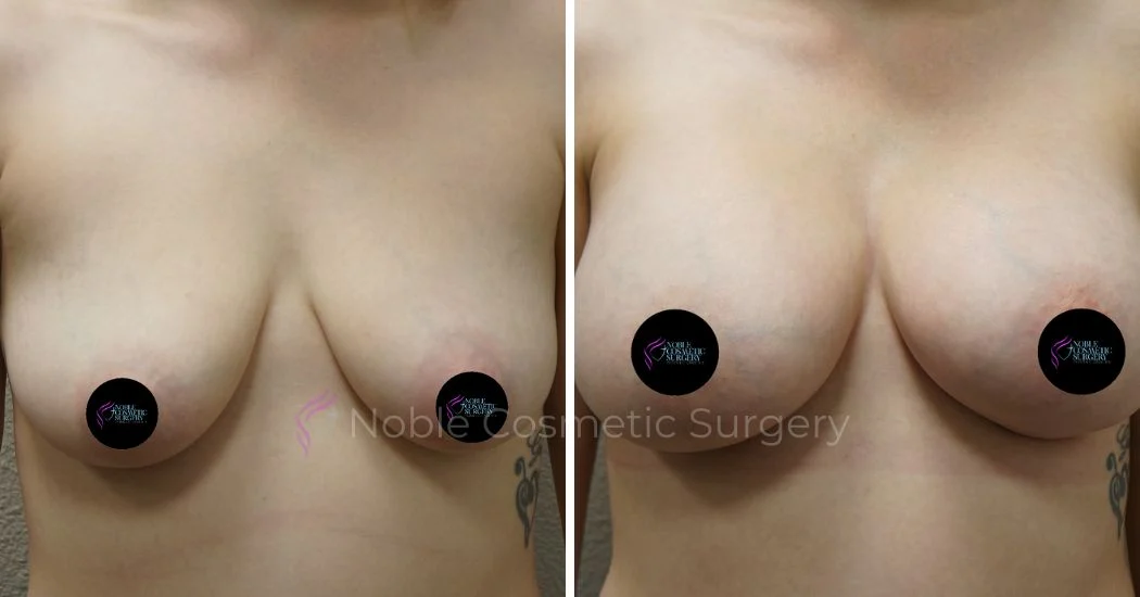 P2-17521 | Before and After Breast Augmentation 1