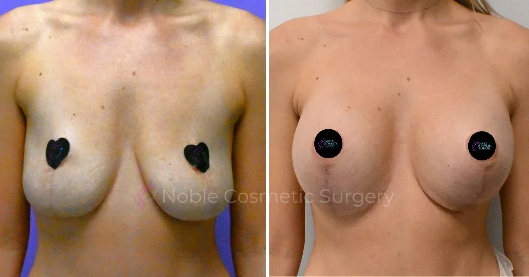 P2-19511 | Before and After Breast Augmentation with Lift 1