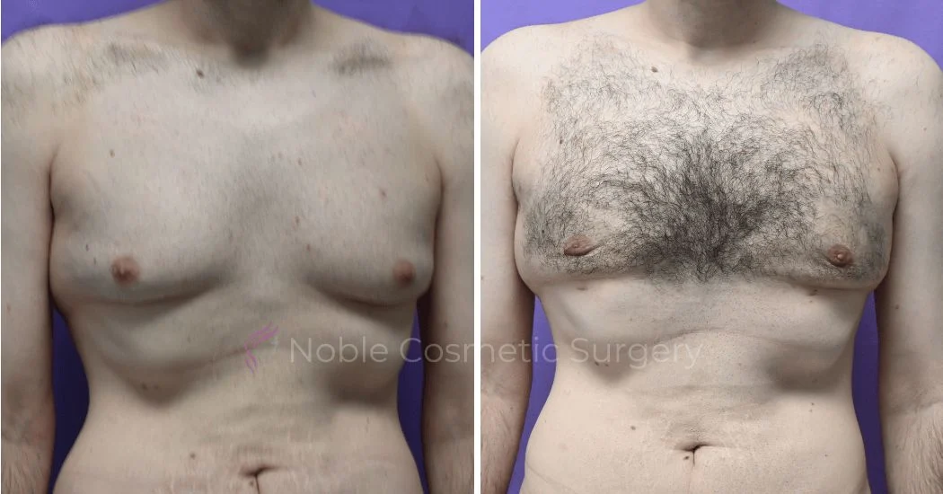 P3-19647 | Before and After Gynecomastia 1
