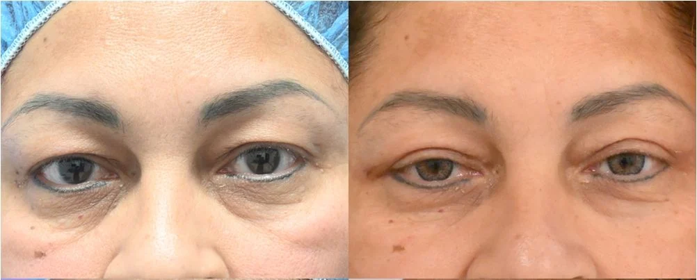 P2-19857 | Before and After Blepharoplasty 1