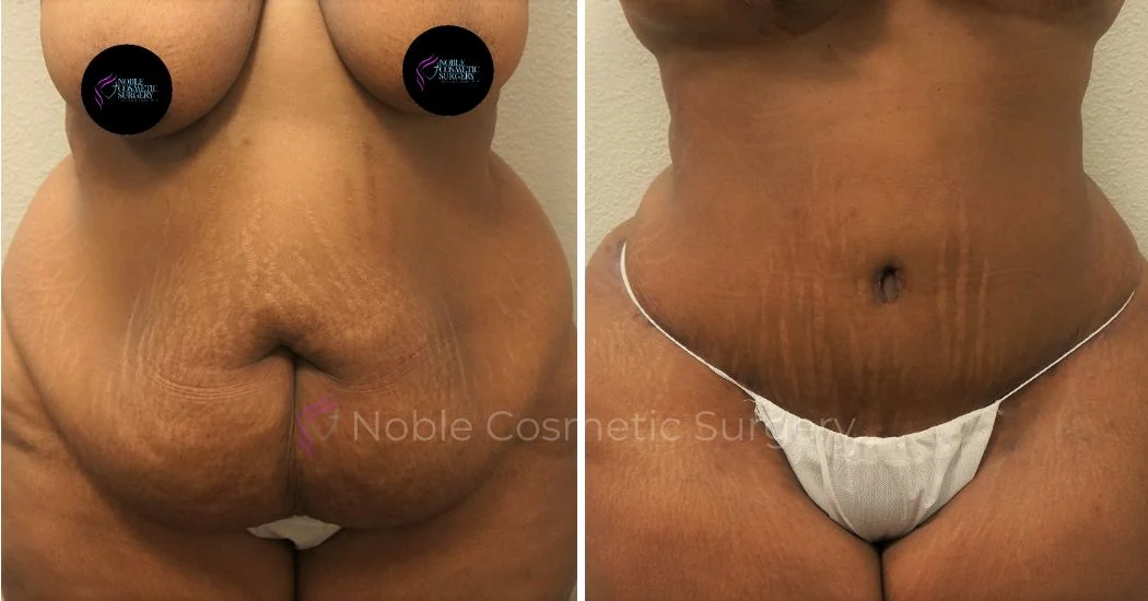 P20-00051A | Before and After Abdominoplasty 1