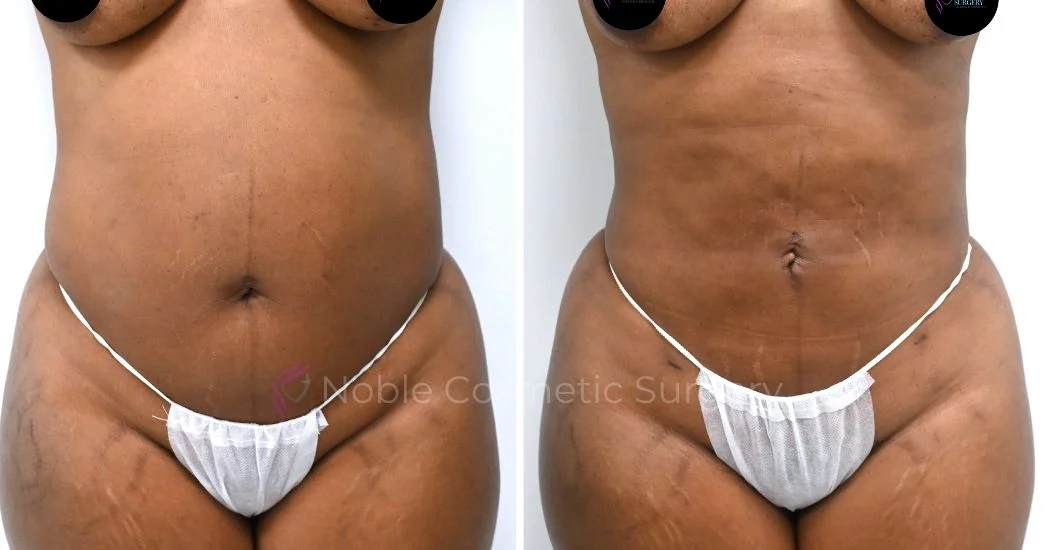 P20-00920L | Before and After Liposuction 1